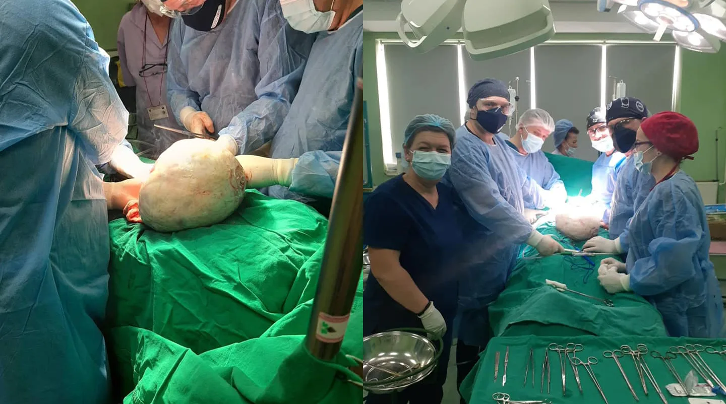 Mjekët në Spitalin e Mitrovicës i heqin një pacientit tumorin me peshë 15 kilogramë