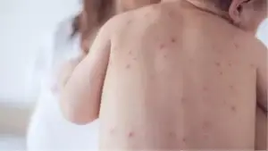 Regjistrohen 8 raste me fruth në Kosovë, IKSHPK u bën thirrje prindërve të vaksinojnë fëmijët